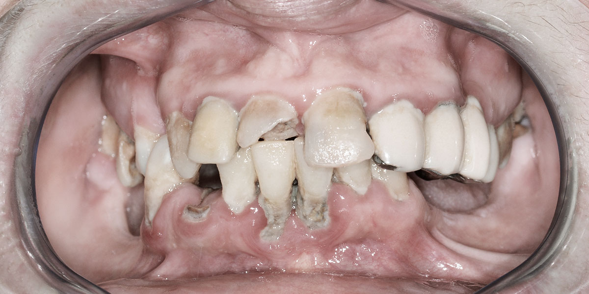 Prieš - Gintarė - pašalinta 11 viršutinio ir 8 apatinio žandikaulio dantų