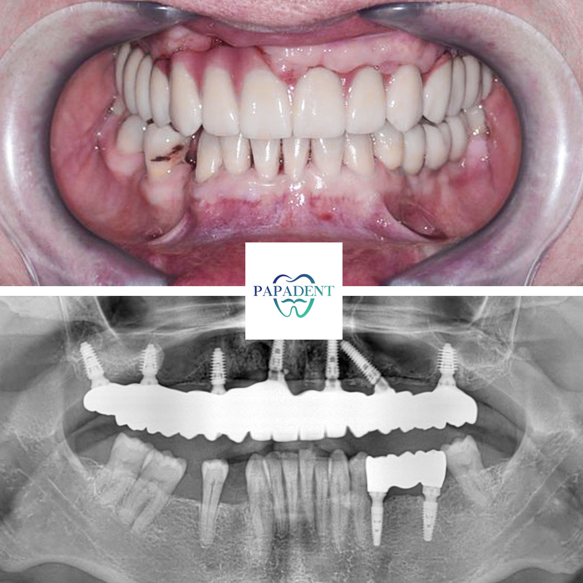 Igoris - All-on-4 dantų protezai - prieš ir po 1