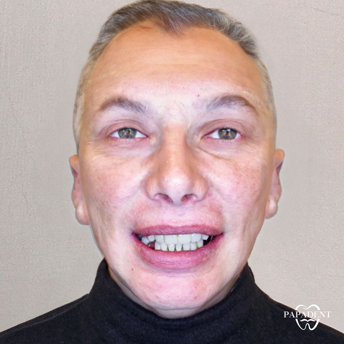 Igoris - Visi dantys ant keturių implantų